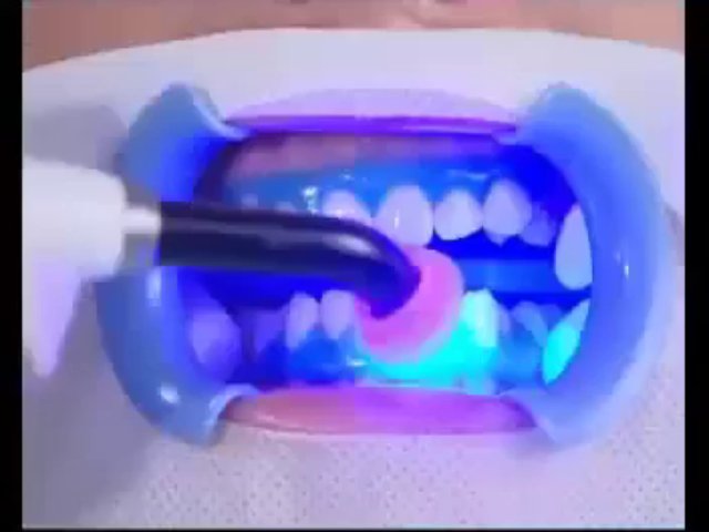laser teeth whitening