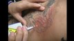 Laser Tattoo Removal torrance | Beverly hills laser hair removal