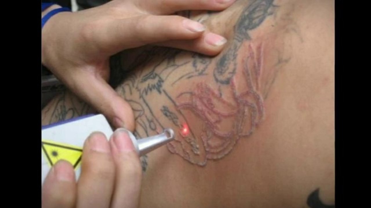 Laser Tattoo Removal torrance | Beverly hills laser hair removal