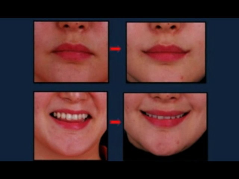 Korean Plastic Surgery Mouth corner lift Smile Lipt1