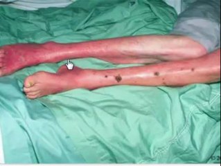 8 Key Signs of Arterial Ulcers & How to Properly Examine Them 🩺