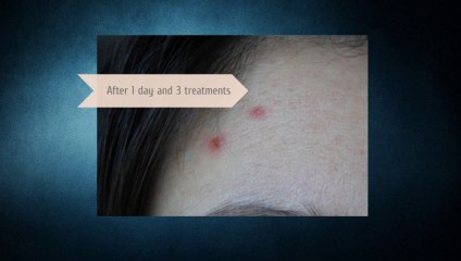 How to heal acne in just 3 days!
