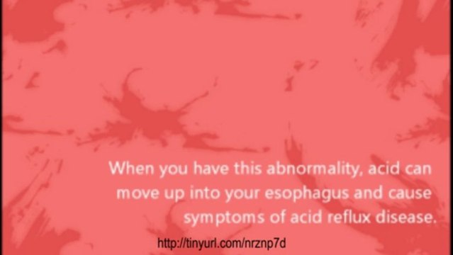 How To Treat Acid Reflux Naturally with Home Remedies Fast and Effective