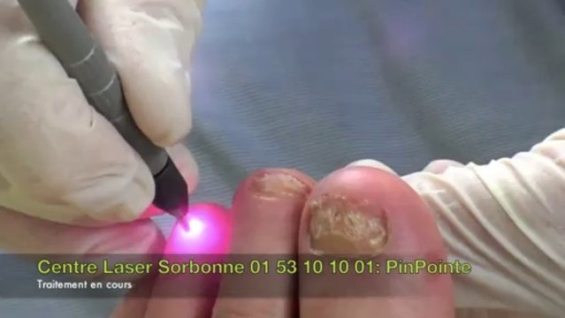 Mycose de l'ongle : Traitement par Laser Yag Multipulse PinPointe™
