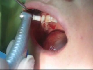 Raspado y alisado radicular