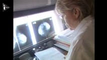 Cancer du sein : un dépistage avant 50 ans ?J