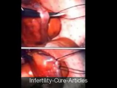 Unexplained Infertility