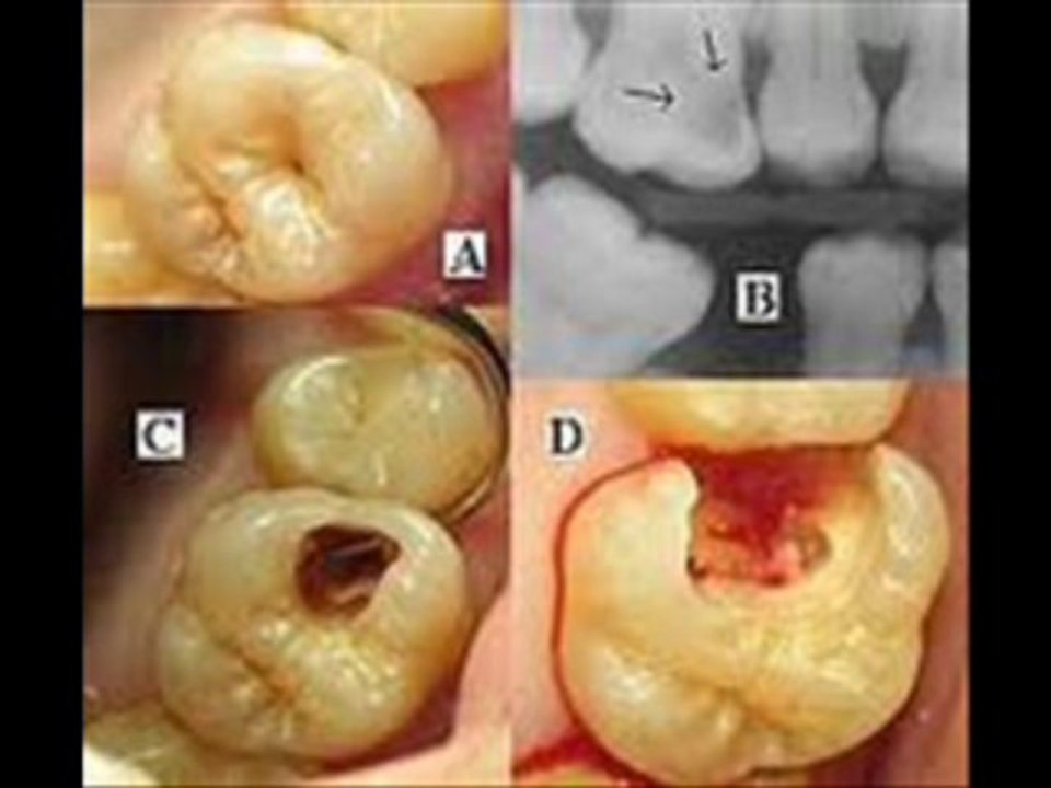 Dr.Robert Tupac DDS Dental cavities
