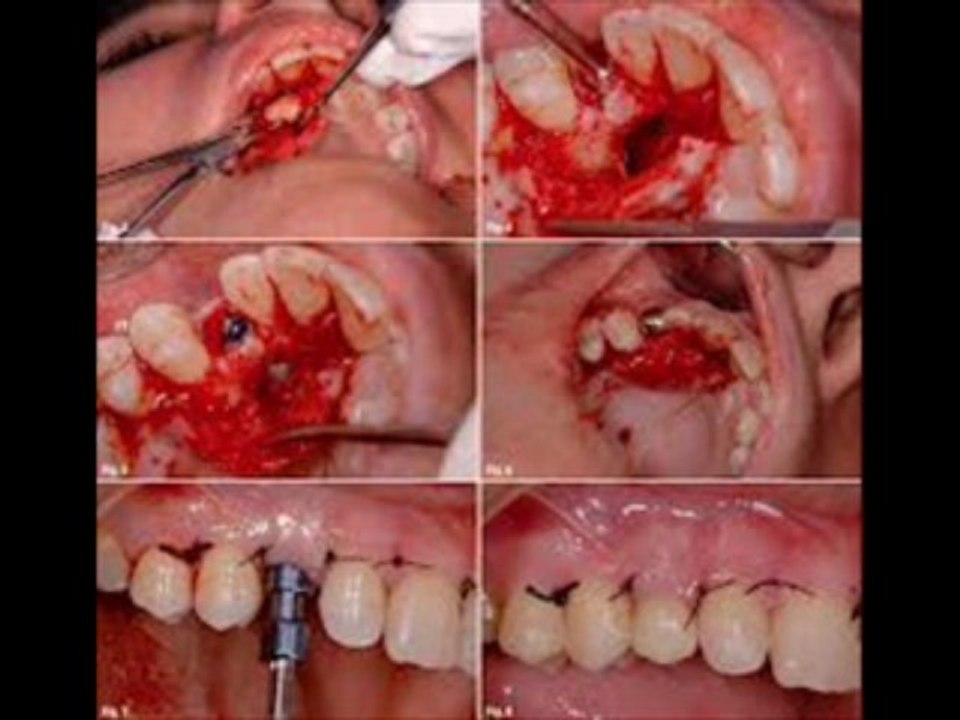 Dr.Robert Tupac DDS Dental extraction