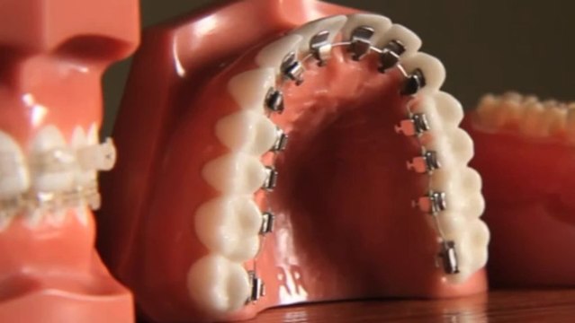 Braces Are Far More Attractive Than Crooked Teeth