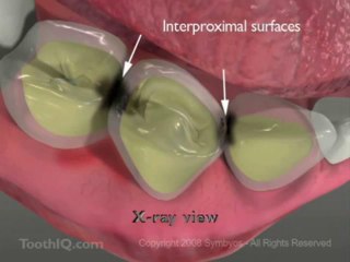 Tooth Decay Dental_Caries