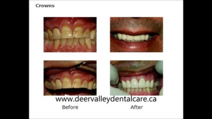 Kids Dentist Calgary - Smile Makeover Calgary
