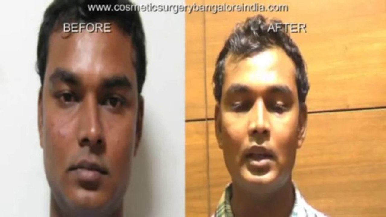 Rhinoplasty Bangalore India Success story