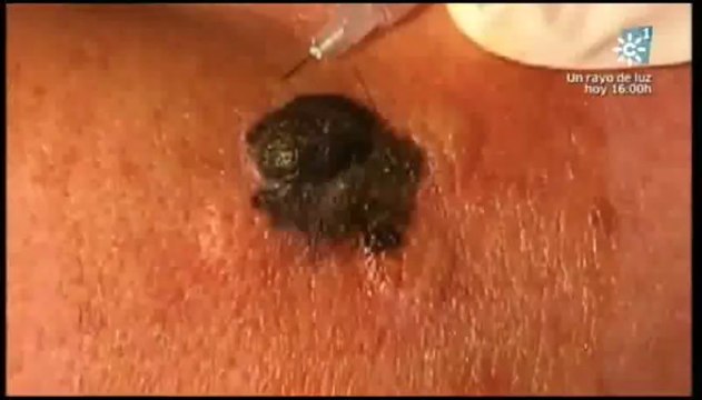 Melanoma: Cancer de piel