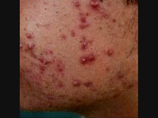 Remedios para el acne