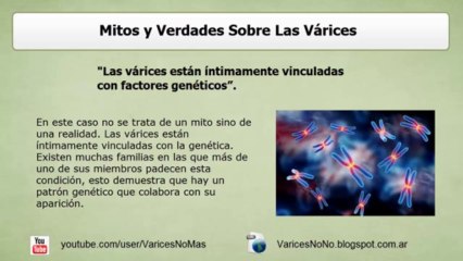 Mitos y Verdades Sobre Las Varices