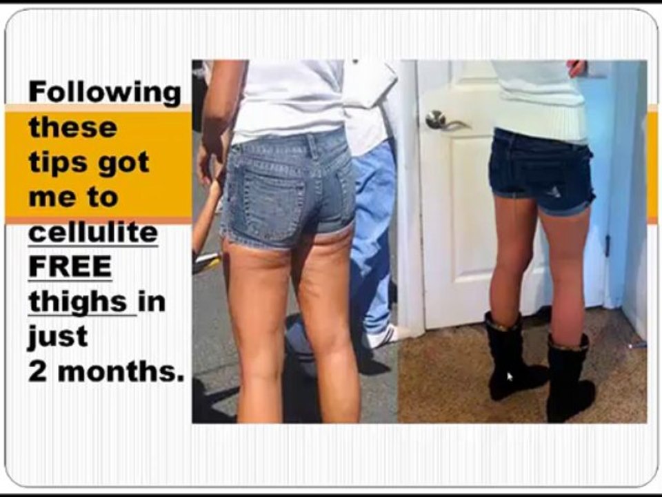 cellulite treatment tip  13