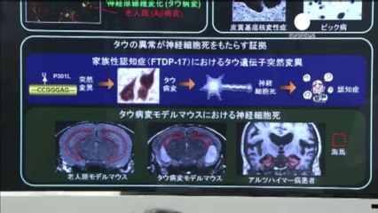 L'imagerie au service de la détection d'Alzheimer