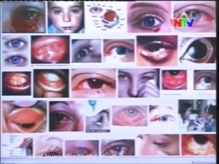 Dịch đau mắt đỏ hoành hành thành phố Vinh