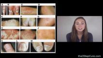 Types of Psoriasis Session 1 - Different Types of Psoriasis Explained