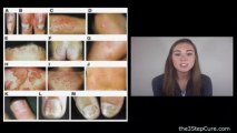 Types of Psoriasis Session 4 - Different Types of Psoriasis Explained