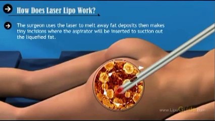 Napoli - Nuove tecniche di liposuzione (21.09.13)