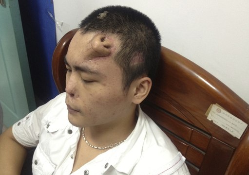 Chine : des médecins font pousser un nez sur le front d'un patient