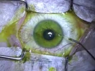 Crosslinking + Laser personalizado no Ceratocone