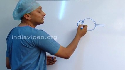 What Is a Cataract? Causes & Symptoms 👁️