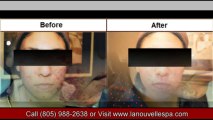 La Nouvelle Acne VideoAcne Treatments Before and After by Dr Hanna | La Nouvelle Medical Spa
