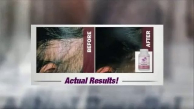 Provillus Review - Hair Loss Treatment