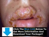 How To Get Rid Of Herpes On Lip   Get Rid Of Herpes Sore Fast