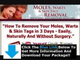 Mole Wart Removal Product Reviews   Moles Warts Skin Tags Removal Ebook Download