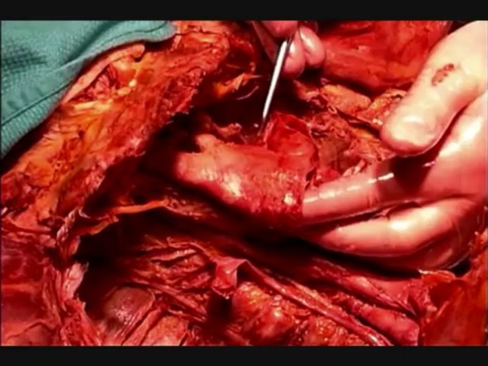 Human Anatomy Dissection 05 (part 2 of 2) Posterior Thorax