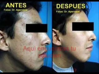 Milagro Para El Acne, Tratamiento natural y efectivo