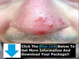How To Get Rid Of Herpes Bumps   Get Rid Of Herpes Sore