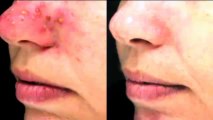 Como eliminar acne - Como quitar el acne - Milagro para el acne