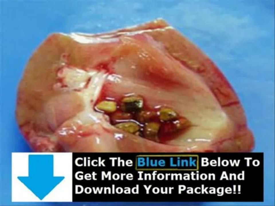 Kidney Stone Remedy Coke And Asparagus + Kidney Stone Tea Remedy