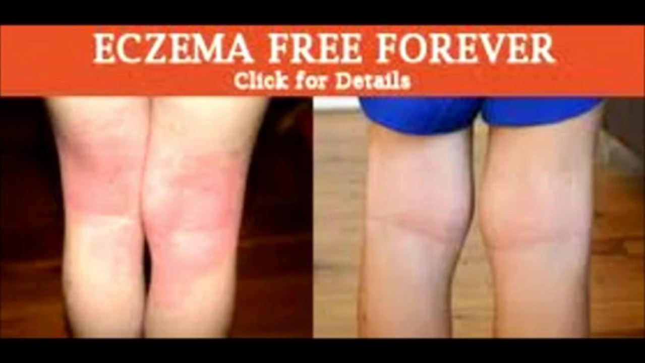 Eczema free forever