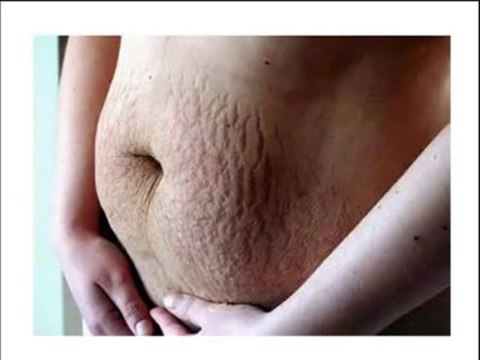 The Scar Solution For Stretch Marks Scars Removal