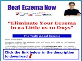 Susan Clark Beat Eczema Reviews   Beat Eczema Ebook Free Download