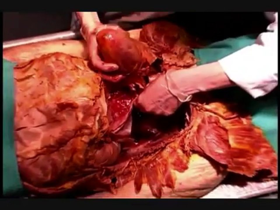 Human Anatomy Dissection 04 part 2 of 2 Thorax