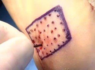 Topaz for Plantar Fasciitis | Weil Foot & Ankle Institute