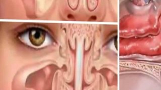 how to cure nasal polyps naturally - nasal polyps treatment