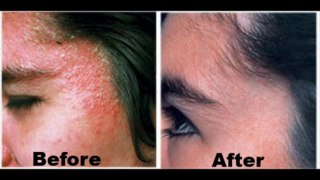 Eczema Free Forever ==GET DISCOUNT NOW==