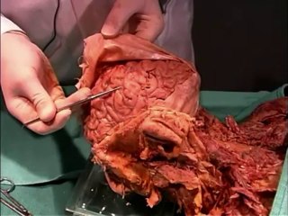 Human Anatomy Dissection 15 (part 1 of 2) Brain