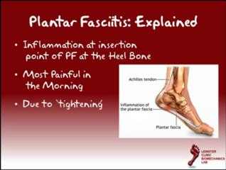 Plantar Fasciitis Explained