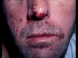 One Minute Herpes Cure Review