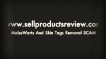 MolesWarts And Skin Tags Removal SCAM-Easily, Naturally And Without Surgery