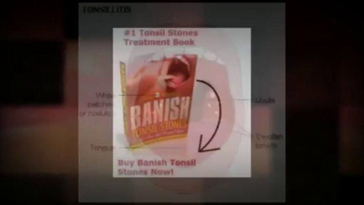 Banish Tonsil Stones - How To Banish Tonsil Stones?